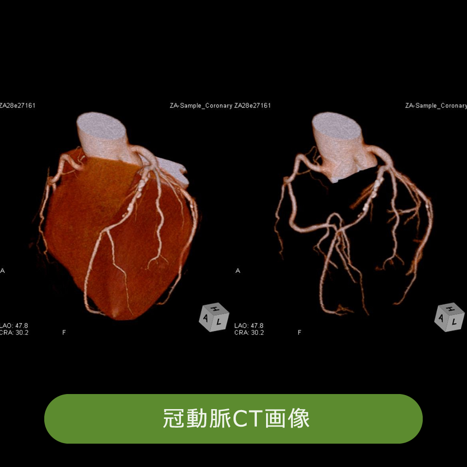 心臓の冠動脈造影CT検査