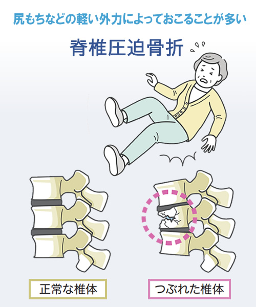 脊椎圧迫骨折とは