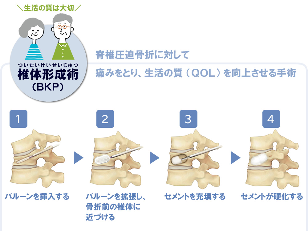 椎体形成術（BKP）
