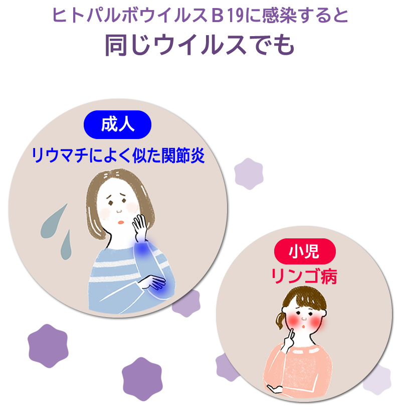 ヒトパルボウイルスB19は成人ではリウマチによく似た関節炎をひきおこします