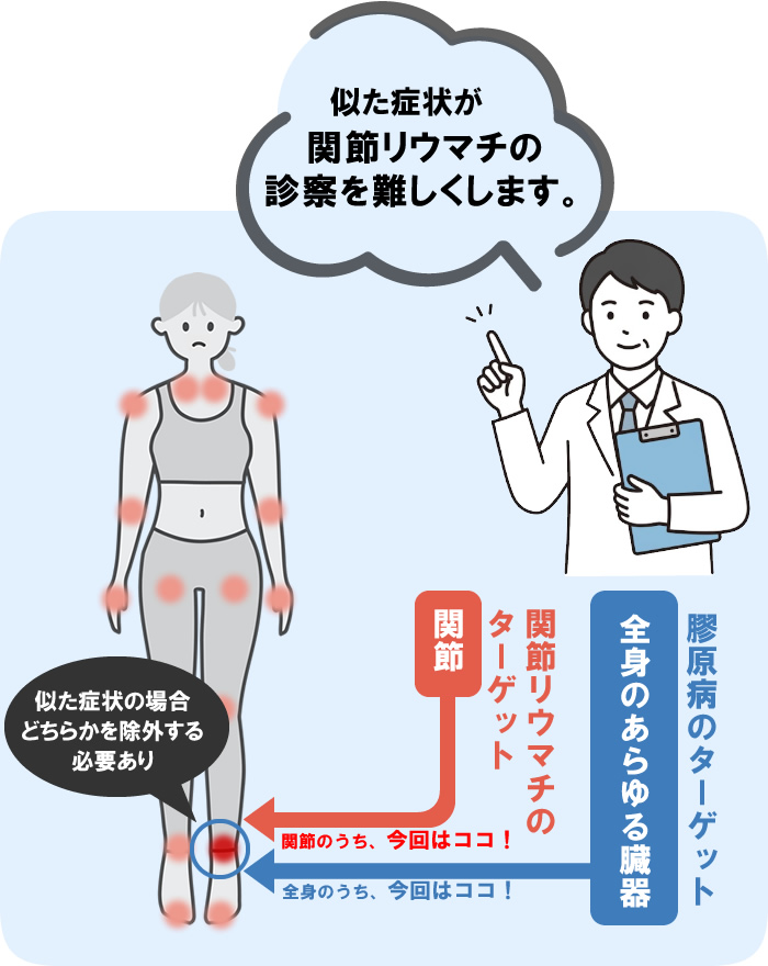 関節リウマチ診断が難しい理由のイラスト