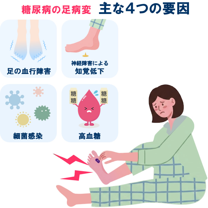 糖尿病の足病変に関わる主な要因を示すイラスト